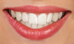 Female mouth with clear aligners