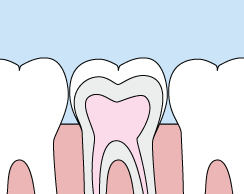 Dental sealant diagram